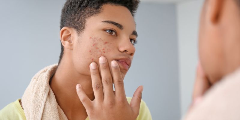Can Drinking Water Clear Up Acne? Simple Answers for Skin Health